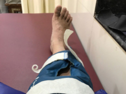 OMG: Arshad Warsi injures his leg during a dance sequence and here is what he said