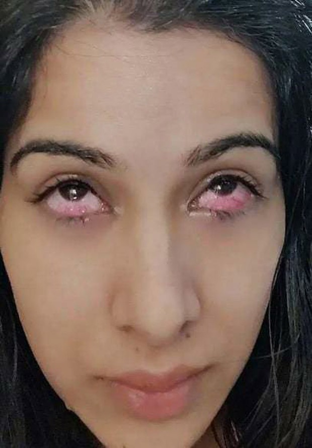 Bigg Boss 14 This picture of Sara Gurpal's eyes' injury by Nikki Tamboli's acrylic nails is shocking!