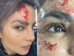 Priyanka Chopra injured on the sets of Citadel, shares photos of her injuries
