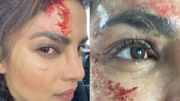 Priyanka Chopra injured on the sets of Citadel, shares photos of her injuries