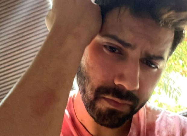 Varun Dhawan shares photo of bruisers on his arm on the sets of Citadel India 
