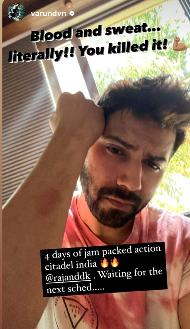 Varun Dhawan shares photo of bruisers on his arm on the sets of Citadel India 