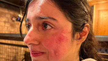 Divya Khosla gets “Badly injured” on sets of her upcoming film; says, “But the show must go on”