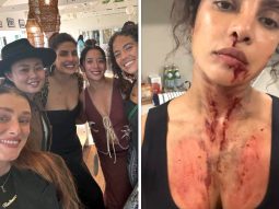 Priyanka Chopra Jonas showcases the ‘glamorous’ side of action as she shares photos of blood and bruise