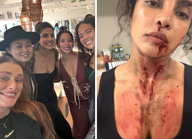 Priyanka Chopra Jonas showcases the ‘glamorous’ side of action as she shares photos of blood and bruise