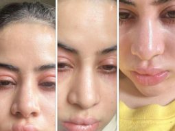 Uorfi shares SHOCKING photos of swollen face and lips, reveals she is “undergoing immunotherapy”: “Fillers nahi hai guys , allergies hai”