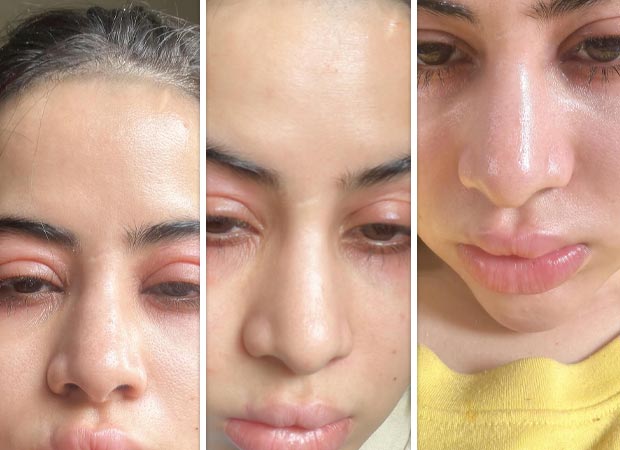 Uorfi shares SHOCKING photos of swollen face and lips, reveals she is “undergoing immunotherapy”: “Fillers nahi hai guys , allergies hai”